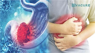How can you stay away from Gastric Cancer
